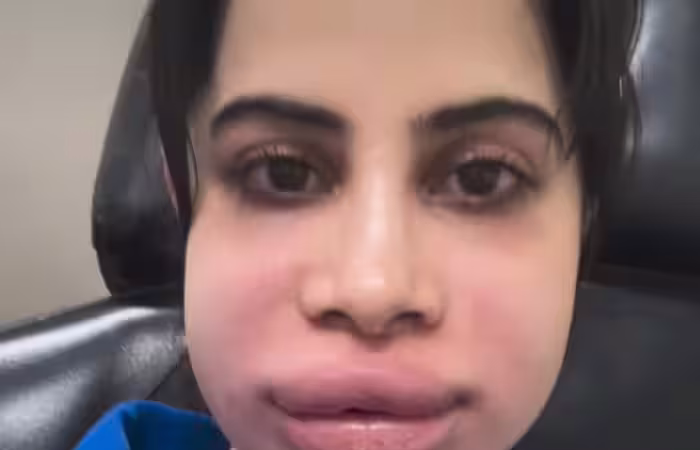 Urfi Javed shows swollen face after lip filler dissolving in viral Instagram video